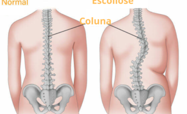 O Que é Escoliose? Entenda Essa Curvatura da Coluna