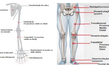 Principais Níveis de Amputação