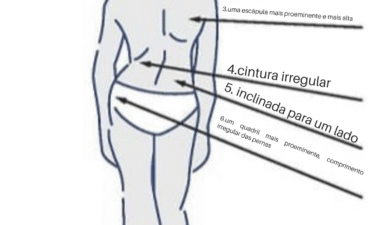 Como Reconhecer a Escoliose em Casa.
